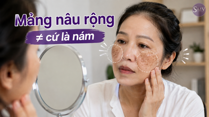 Mảng nâu rộng ≠ cứ là nám Mảng nâu rộng ≠ cứ là nám