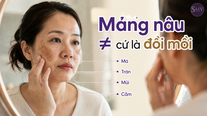 Mảng nâu ≠ cứ là đồi mồi Mảng nâu ≠ cứ là đồi mồi