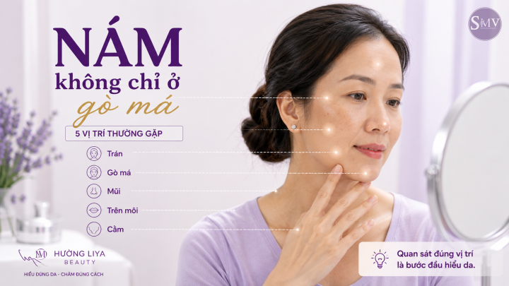Nám không chỉ ở gò má Nám không chỉ ở gò má
