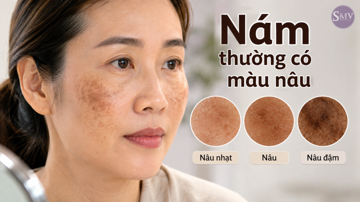 Nám thường có màu nâu Nám thường có màu nâu