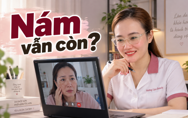 Nám sau sinh có gì đặc biệt 7 điều mẹ cần biết để chăm da